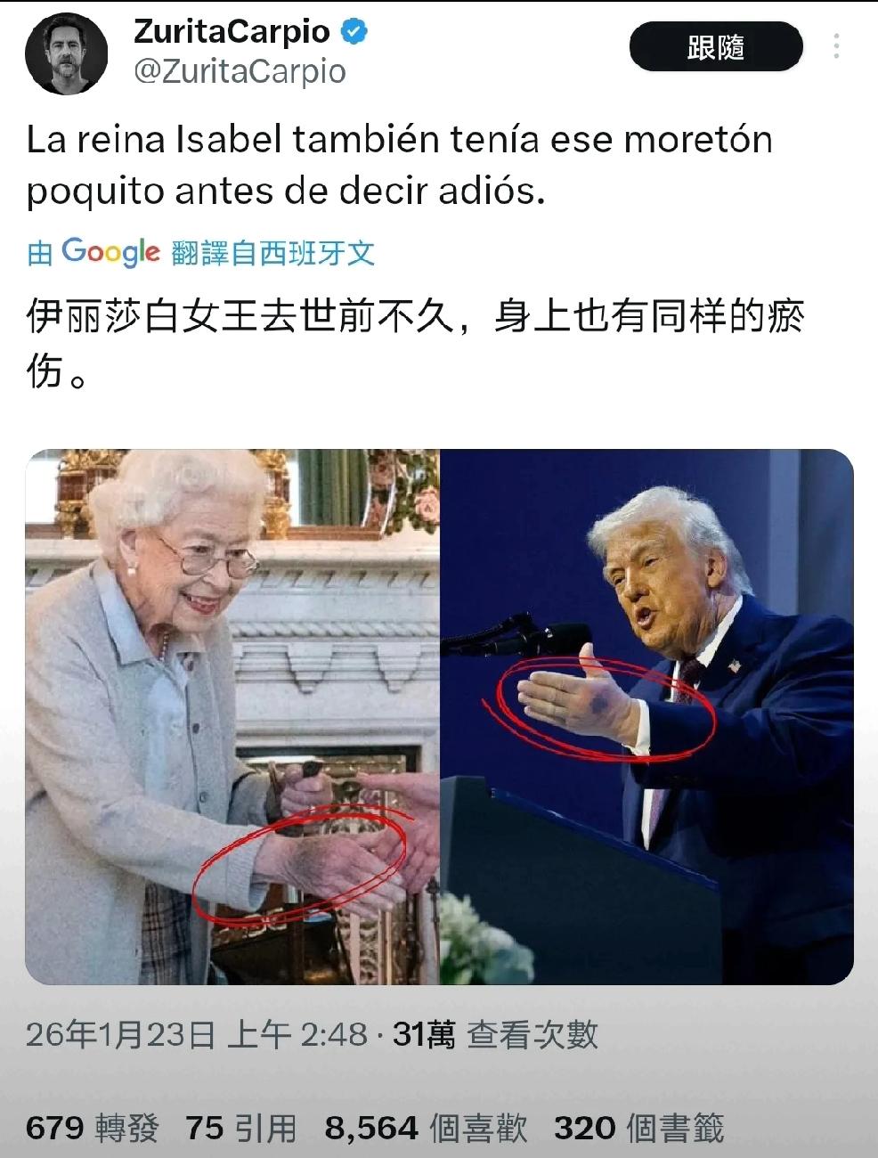 外媒发文：“伊丽莎白女王去世前不久，身上也有同样的淤血。”个人认为：特朗普