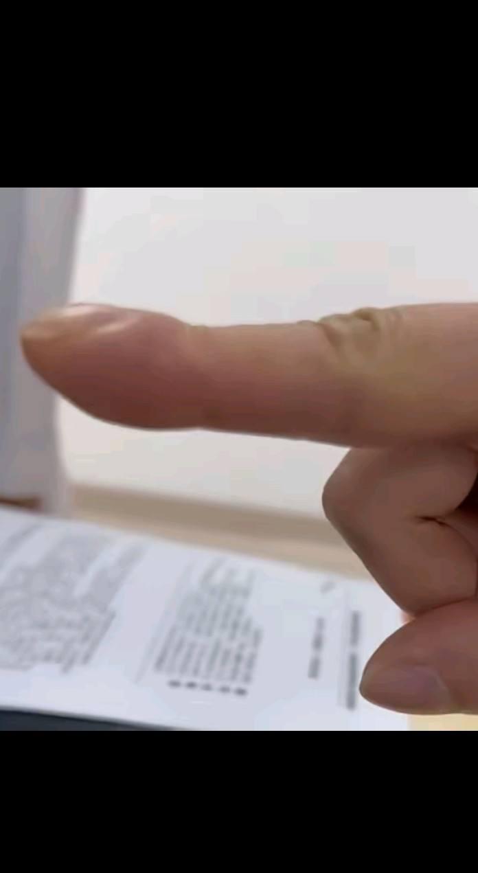 昨天去医院开药，前面一个患者在让医生看CT，医生还让他伸出手指，医生说这是典型的