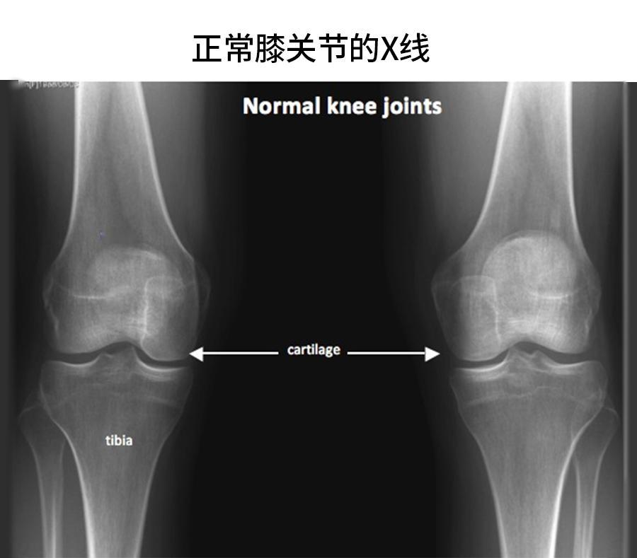来看【正常】膝关节和【骨性关节炎】膝关节的片子——尤其是软骨，正常的膝关节，那条