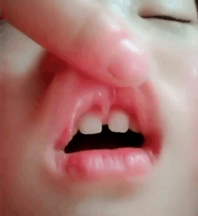实拍: 你们家宝宝有没有这种情况, 我今天才知道这个需要手术!