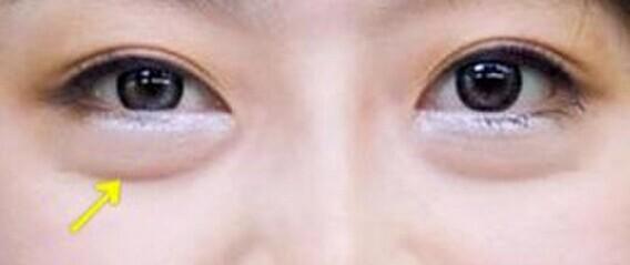 轻松去眼袋 五个小妙招作用大