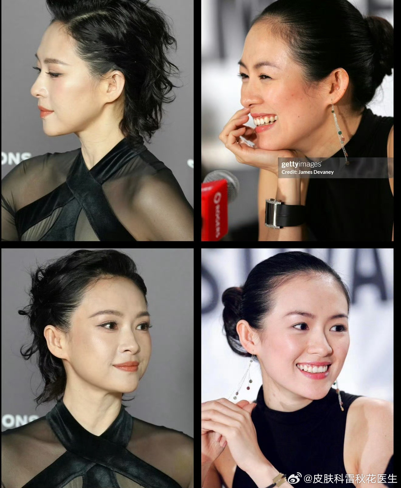 #章子怡脸#她大概率是面部外轮廓做了填充，内轮廓做了修饰，整体而言，还原了她面部的流畅度，又保留了她
