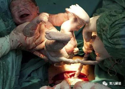 剖腹手术全过程, 心疼产妇, 下辈子不想再当女人了!