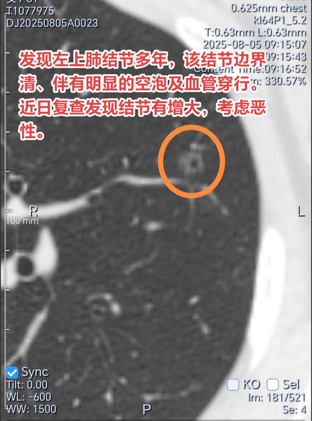 磨玻璃结节有空泡、边界清，需警惕恶性。发现左上肺结节多年，该结节边界清...