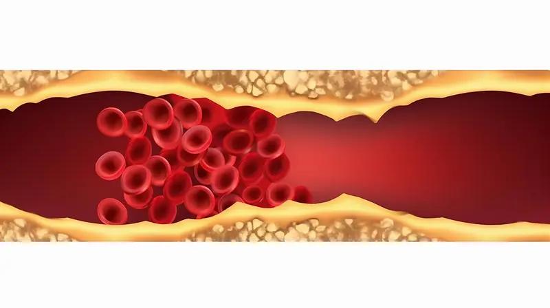 血管堵塞可不是小事，早期症状得留意。脑血管堵塞，也就是脑梗、脑卒中，患者可能出现