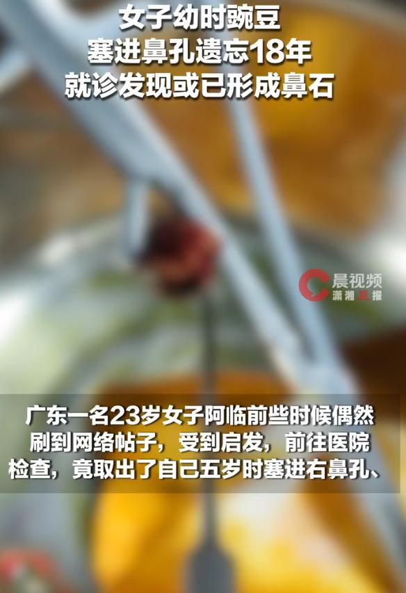 广东，一23岁女子在5岁时因为好奇，把一颗皱皮豌豆塞进右鼻孔，想试试能不能从鼻孔