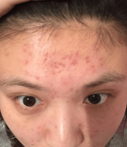 脸上长痘痘怎么消除呢?
