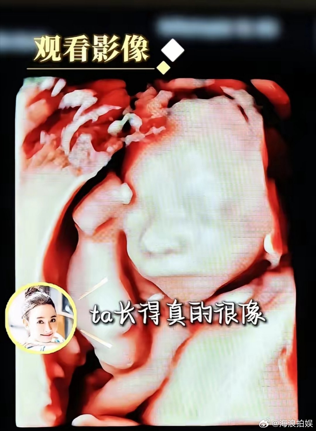 任重陪妻子孙骁骁一起产检，给二胎孩子做四维，孩子的四维照片很清楚，孙骁骁说鼻子像自己。​孙骁骁二胎也
