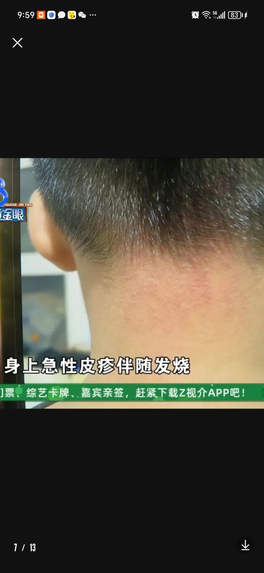 正规医院，这操作简直离谱！孩子身上摸起来还是磨砂感，毛毛糙糙的！一场发烧治疗