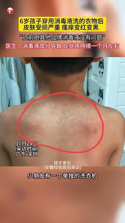 深圳家长给娃洗衣太“拼”!加1瓶盖消毒液想杀菌,结果成“皮肤刺客”。6岁娃