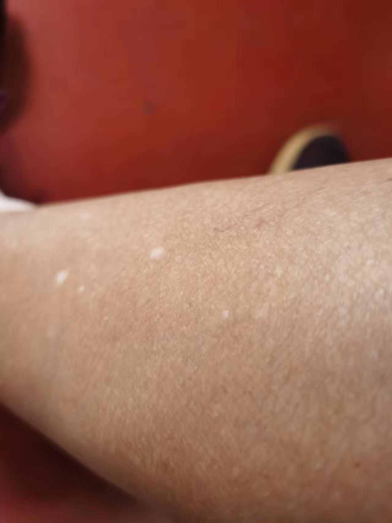 求助！腿上的小白点蔓延全身了，有同款情况的吗？头几年在腿上发现了个圆圆的小