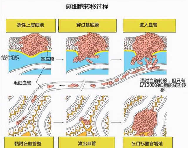 肺癌一站式科普第26期: 浸润是恶性肿瘤的标志性特征