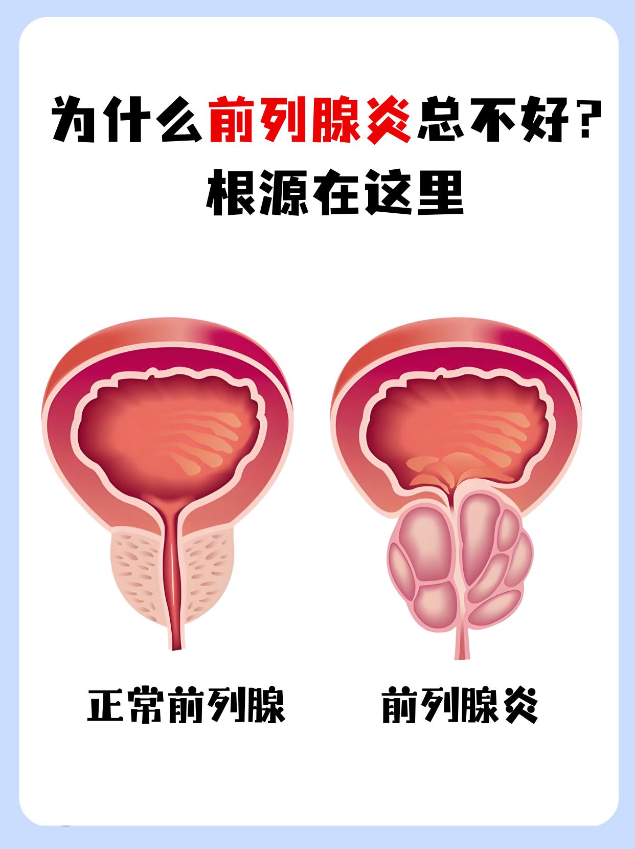 90%的前列腺炎不用过度治。很多人确诊前列腺炎，或是有小腹坠胀、尿不尽等情况，就