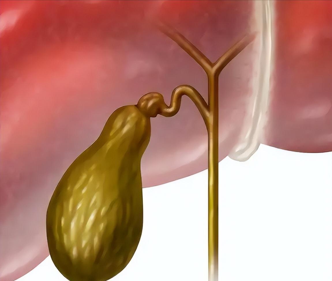 身边有人切胆囊后吃油就拉，有人没切却查出胆囊癌！这东西切了有啥麻烦？不切会癌变吗