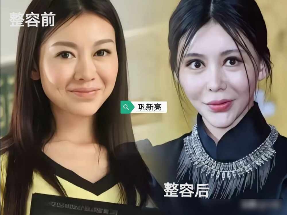 谁还记得她们以前长什么样。现在一个个顶着同款大眼尖下巴，脸僵得连哭都像在笑。早几年蛇精脸最火那阵，全