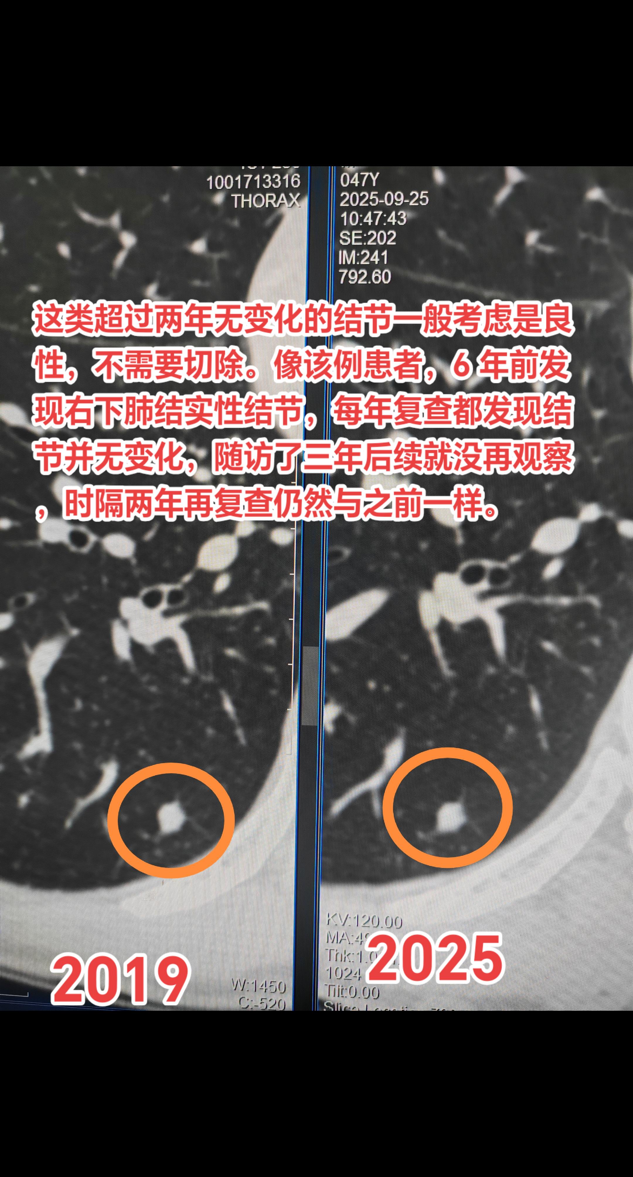 这类实性结节一般考虑是良性，不需治疗。这类超过两年无变化的结节一般考虑...