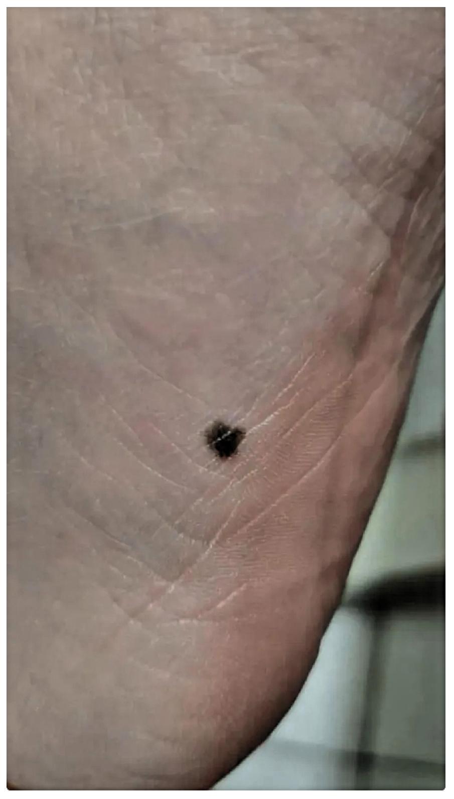 因为脚底一个痣，生命永远定格在了38岁。老家邻居家儿子今年38岁，脚底下长了