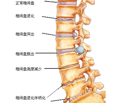 得了强直性脊柱炎就会脊柱变形吗?