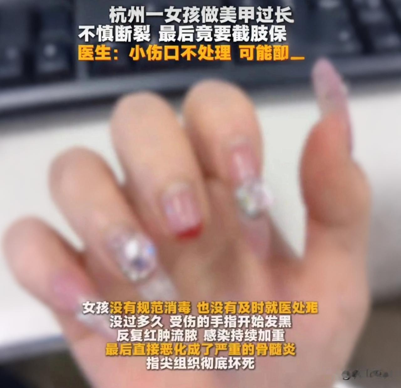 24岁女孩做超长美甲，指甲掀开没当回事，最后惨遭截肢！看到用户的爱美需求，我
