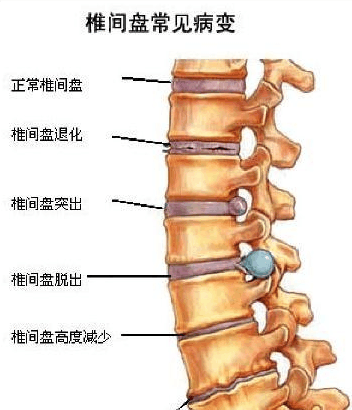 扭脖子会“嘎嘎”作响, 是不是颈椎病? 内有福利