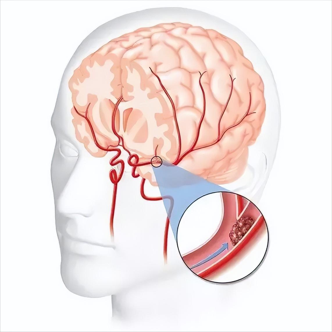 脑梗患者过冬三要诀，一个都不能少！ 1.保暖不是小事很多患者觉得