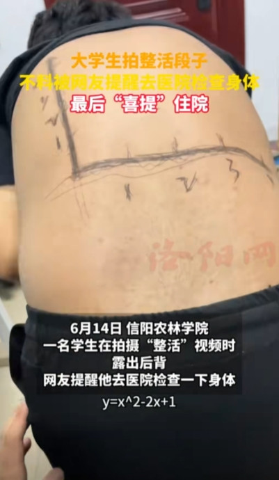 河南一小伙在抖音上拍了个露背的视频，本来是想逗大家开心的，不料网友看到他后背长了