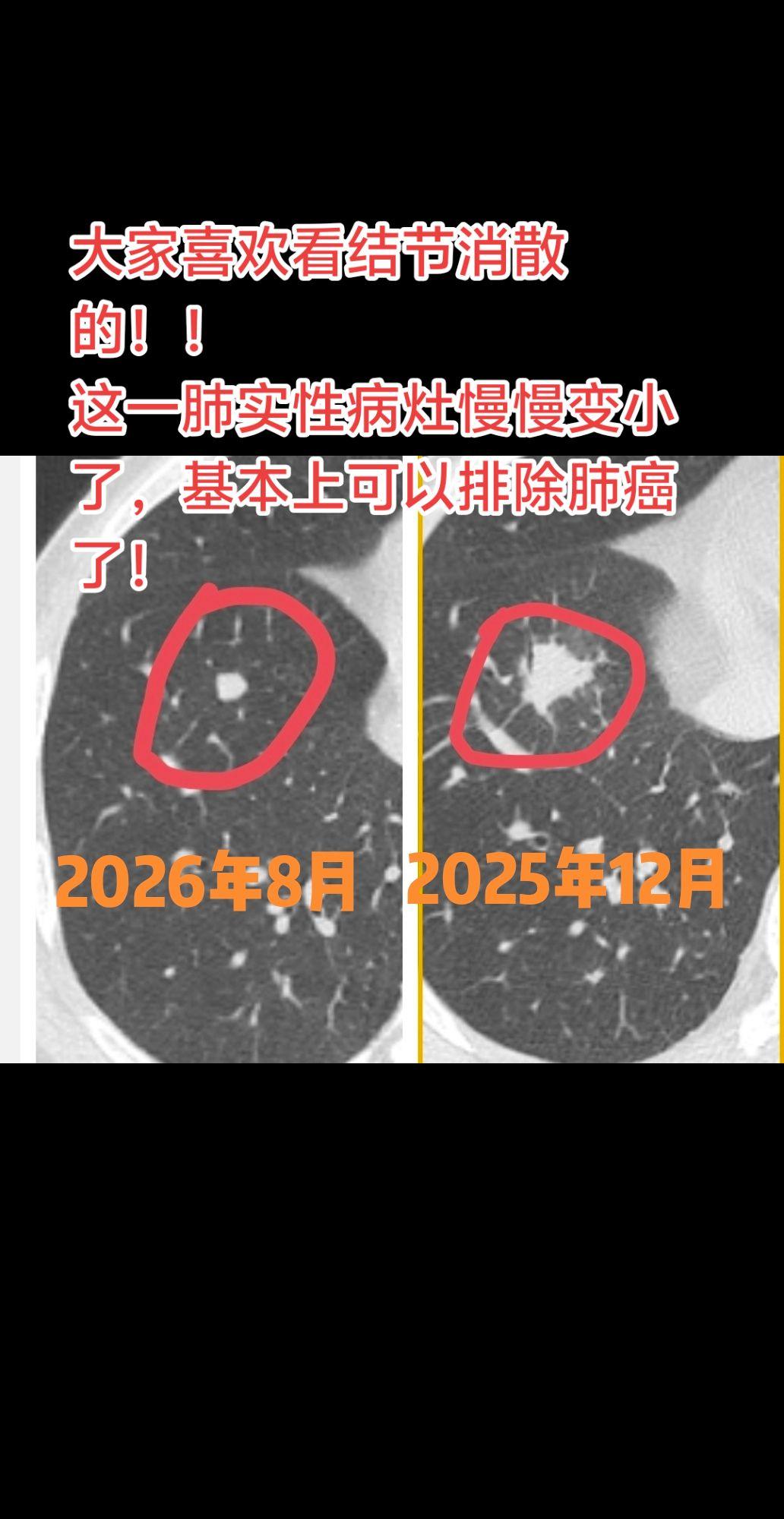 变小的实性肺结节。大家喜欢看结节消散的！！ 实性病灶慢慢变小了，基本上...