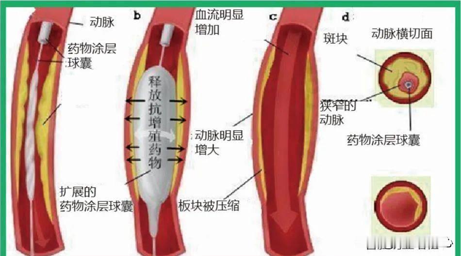 药物球囊和支架有什么区别？前几天一个朋友私信问我这个问题@悠闲小青蛙，一直没有