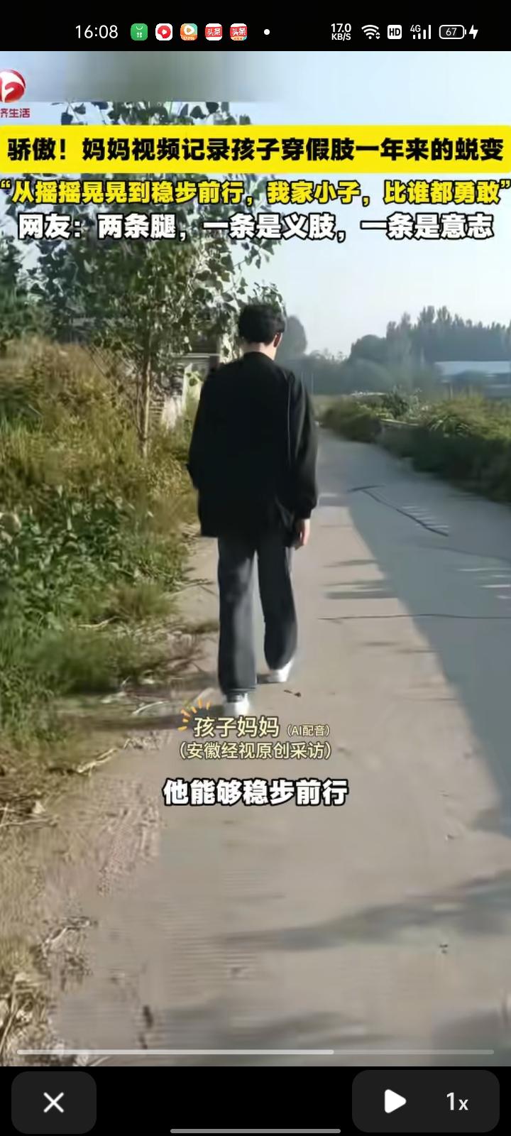 9月13日，山东临沂。孩子妈妈记录儿子穿假肢一年来的蜕变，开始是摇摇晃晃，训练时