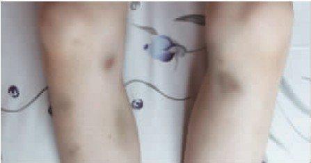 四岁宝宝双腿怎么总是青一块紫一块, 该不是白血病吧?