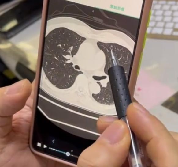 体检发现肺里有3-4mm的磨玻璃结节，先别慌！这其实很常见。这么小的结节，在医学