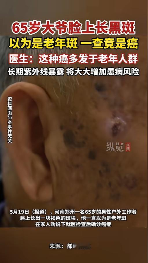“万万没想到！”5月20日报道，河南郑州，一位65的大爷脸上长了块褐斑，他以为是