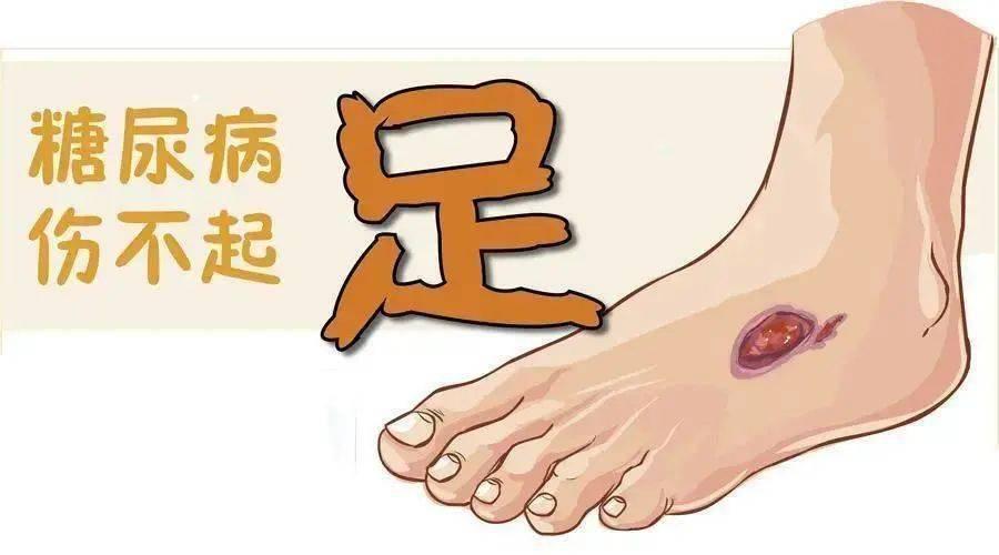 如何判断糖尿病足？有周围神经病变就是糖尿病足么？脚没烂，但麻了、胀了，走路跟踩