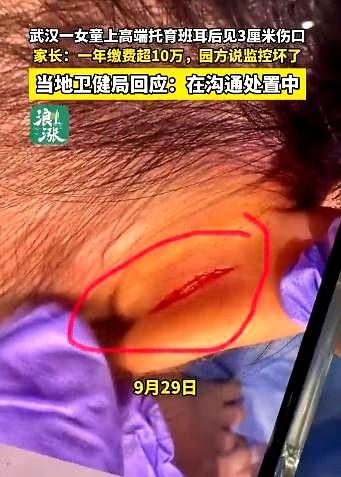 湖北武汉，邓女士孙女在高端托儿所耳朵受伤，医生诊断为大力拉扯撕裂伤。老师称未目