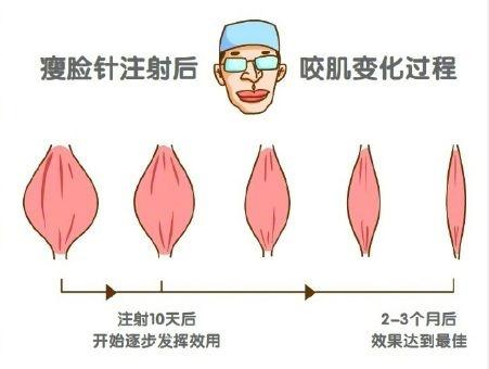 想要脸瘦 注射瘦脸针前后一定要注意这些