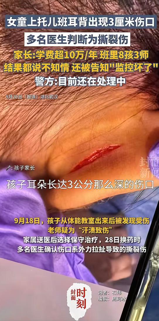 最担心的事情还是发生了！女童上十万一年的托儿班，回家后耳背上竟出现3厘米伤口