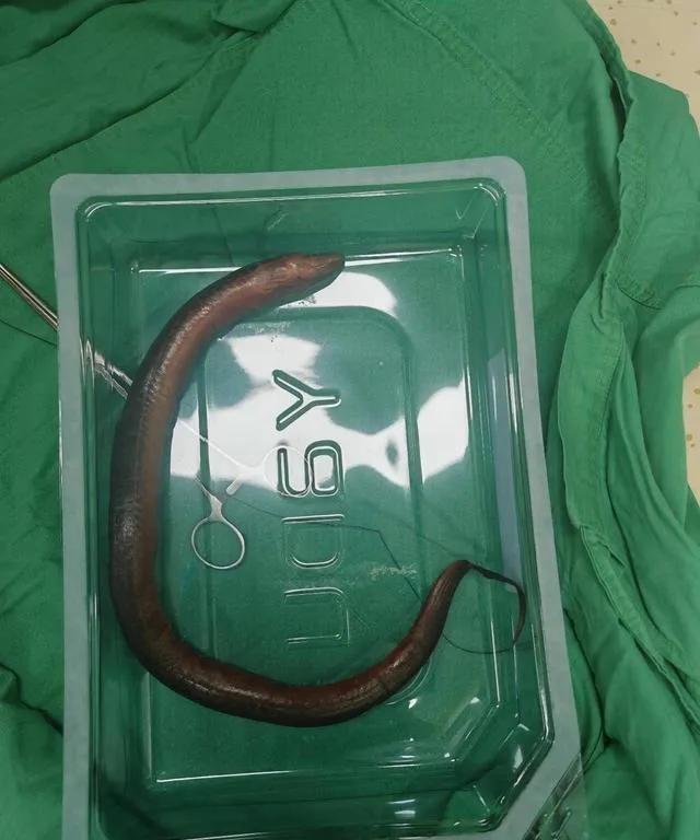 一条黄鳝“活着”钻进一男子体内…就想问问这名30岁的湖南怀化男子，这条大约30