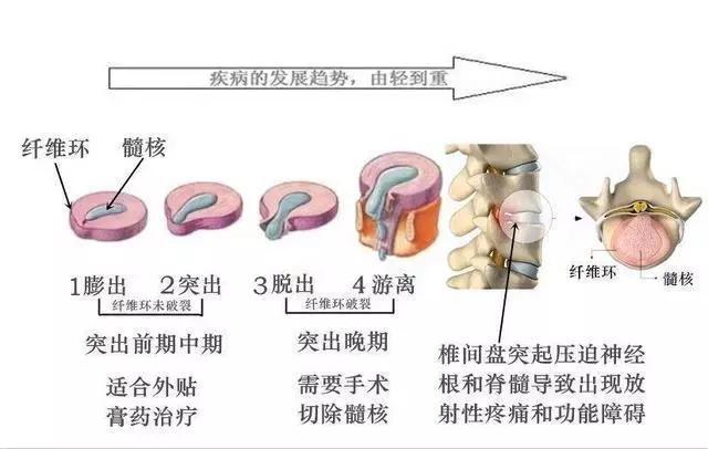 保守治疗腰椎间盘突出症, 效果不好的原因是什么(看懂少走弯路)