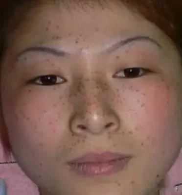 老年斑的调理方法老年斑不是老年人才有，有的百岁老人也不长斑，