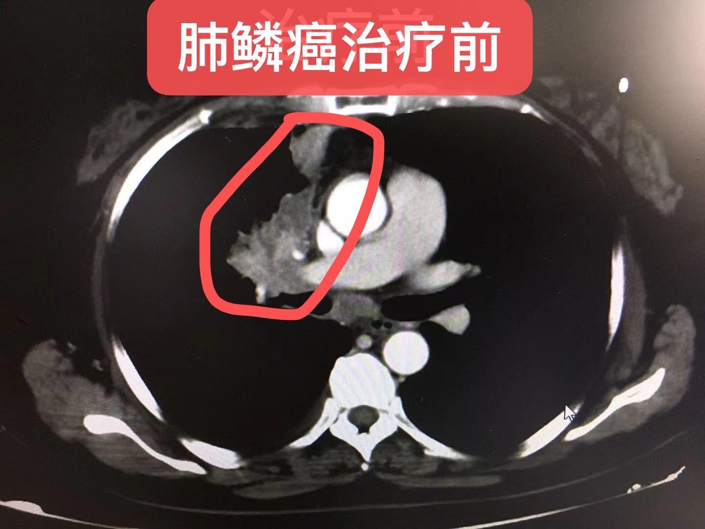 局部晚期 肺鳞癌 的新辅助治疗。男，66岁，肺鳞癌，局部晚期，采用化疗...