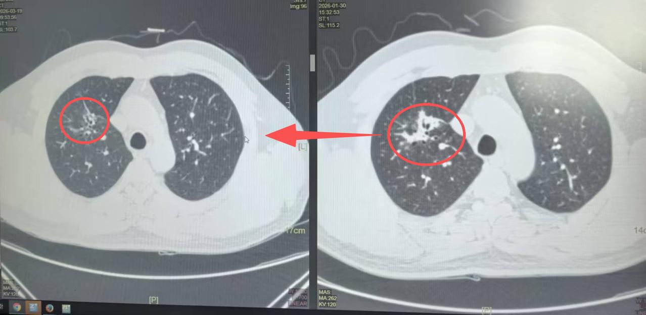 肺癌有了淋巴结转移，不代表就没有希望！肿瘤能明显缩小甚至完全消失......这个