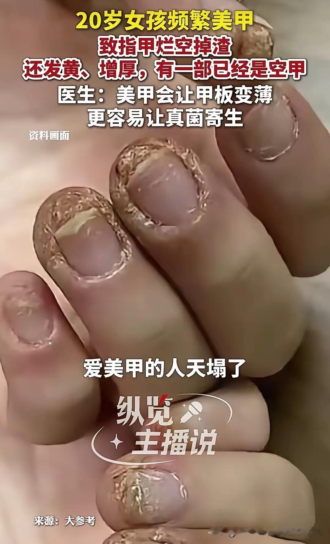 你以为这是农民的手，错了！这是个20岁姑娘的手，就因为频繁做美甲，指甲烂得空了、
