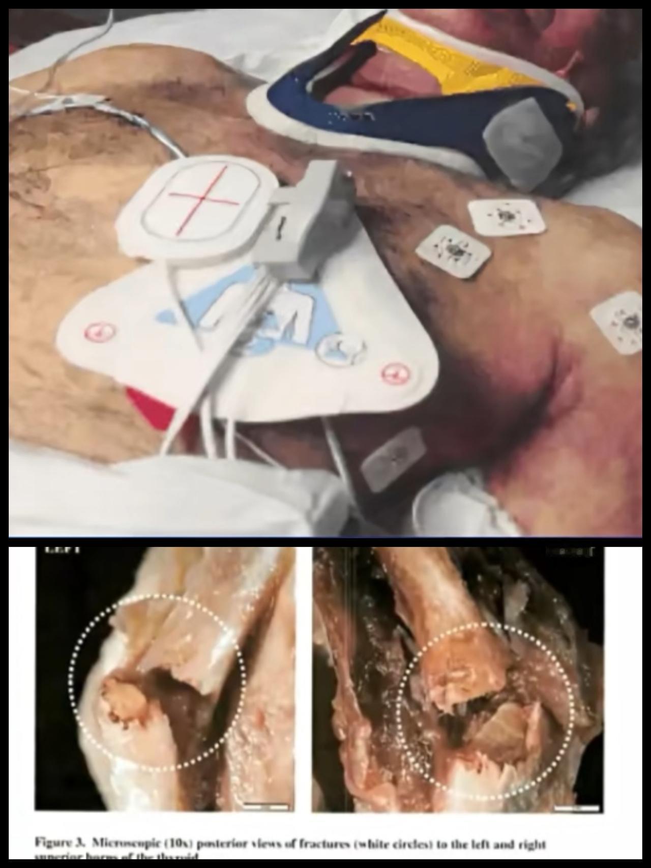 爱泼斯坦“自缢”后照片首度公开：面部红肿骇人，甲状软骨几乎完全折断。自杀是不可能