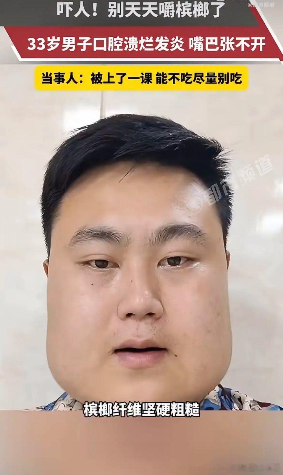 脸都能从尖的嚼成方的，这东西得多狠。湖北33岁男的，15岁开始嚼槟榔，嚼了18年