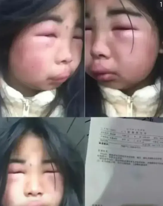 12岁女孩被八名同学轮流扇耳光，导致面目全非，耳膜穿孔，八位施暴者家长道歉被拒，