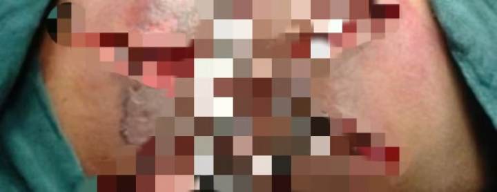 29岁姑娘屁股痛以为“上火”, 肛周组织被持续“蚕食” , 24小时后高烧不退住进ICU! 医生: 再晚几小时或要命