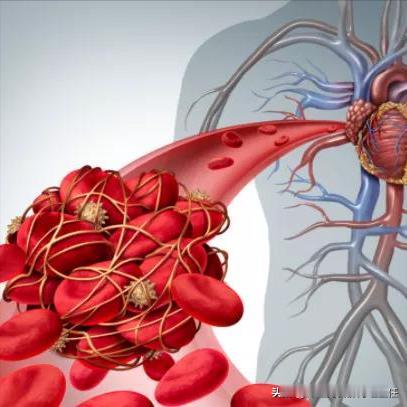 血栓最怕这六种食物了，看到就快存下吧！ 血栓与我们的日常生活息息相关，不良的