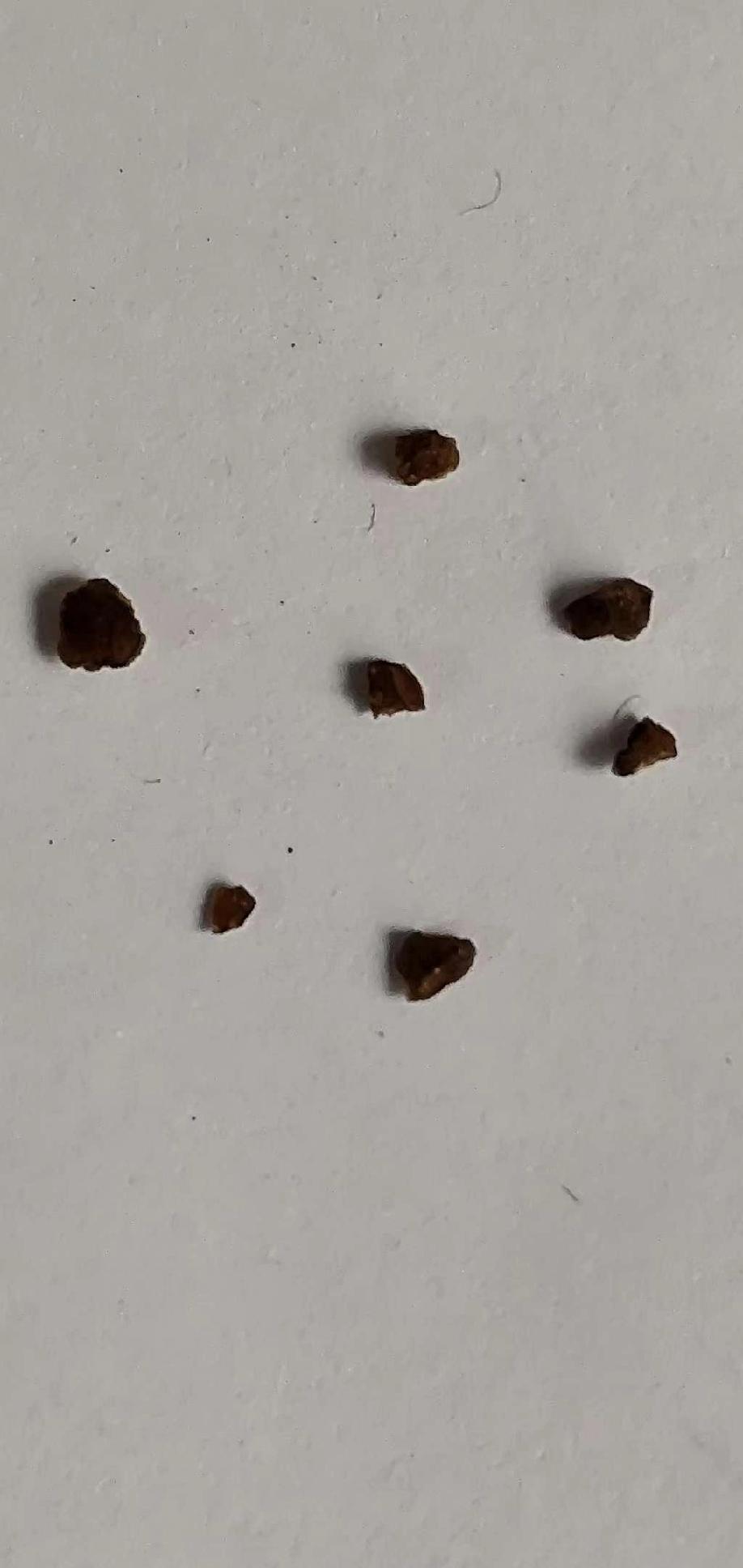 肾结石体外碎石多久后能排出?这个是不确实的。石先生去年体外碎石后，结石没排出来