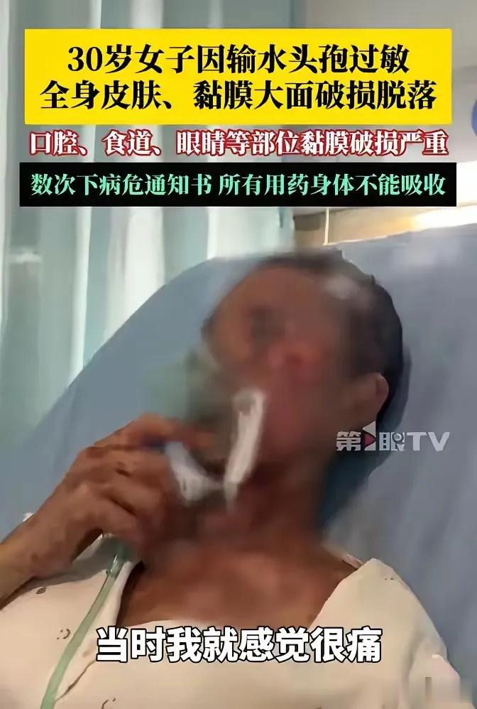 一个小小的感冒真的是差点要了她的命。身上的80%的皮肤都在往下脱落，入住ICu