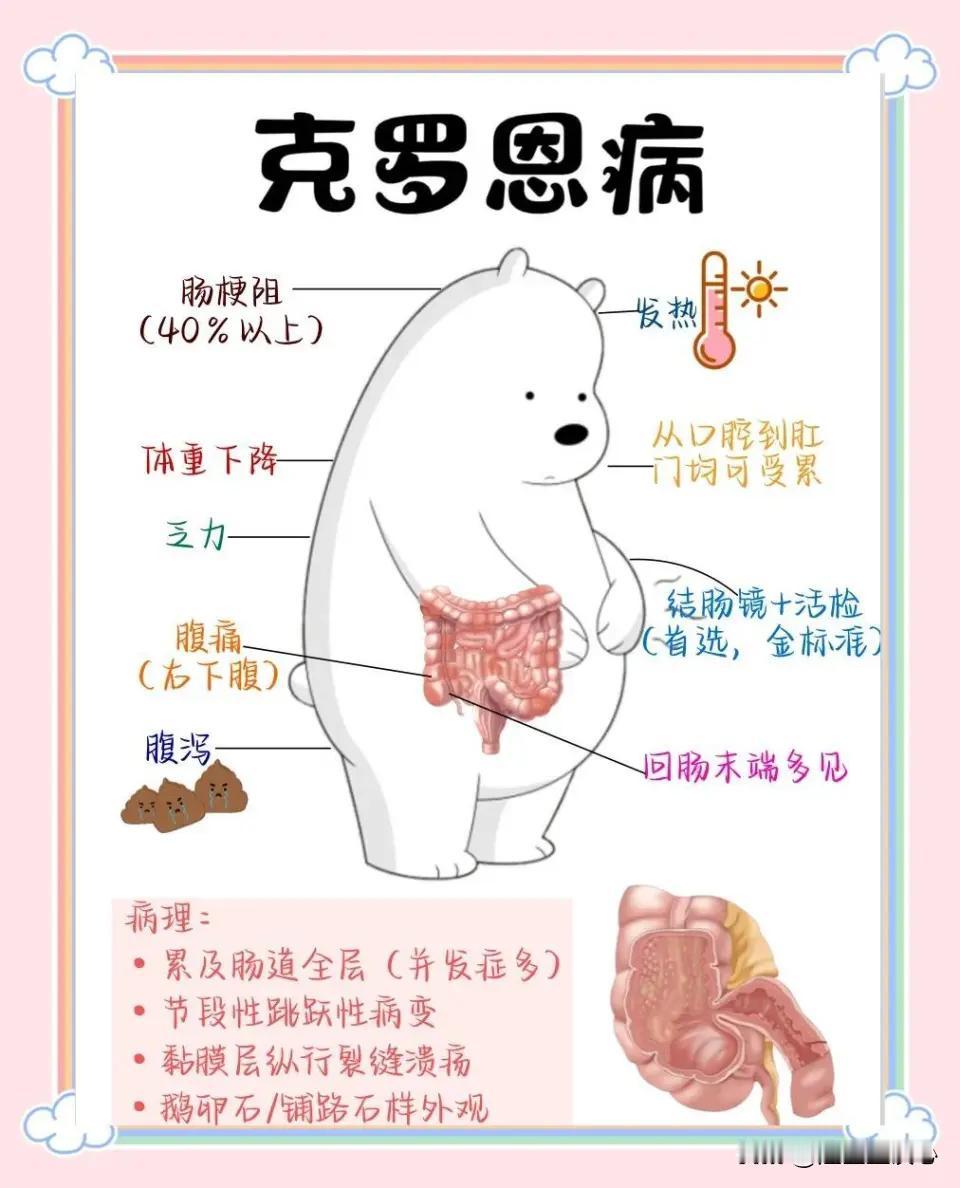 近期一则关于“克罗恩病”的新闻，让这个名不经传的疾病进入大家视野。克罗恩病其实是